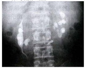 馬蹄腎合併左腎結石