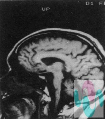 遺忘障礙大腦X光片
