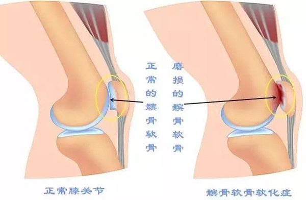 膝關節髕骨軟化