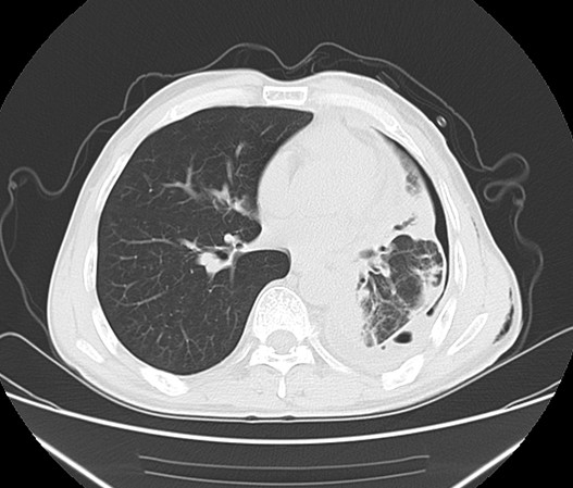 圖2. 左毀損肺