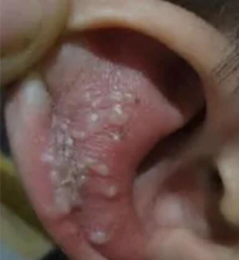 耳部皰疹 耳部皰疹