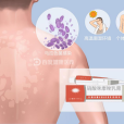 花斑糠疹(汗斑) 花斑糠疹(汗斑)