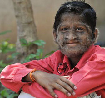 圖:印度的多毛症小男孩