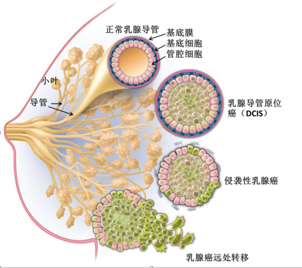 乳腺導管內原位癌