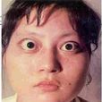 癭腫 癭腫