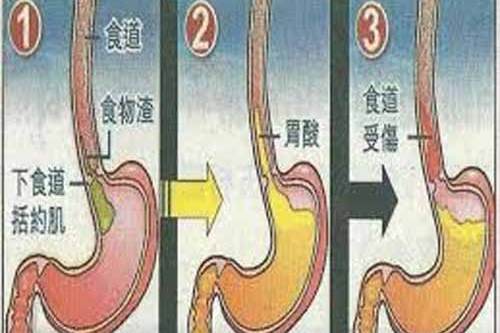 胃反酸 胃反酸