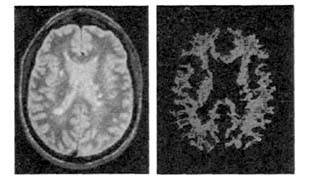 圖2腦部圖像和區域生長法分割的結果