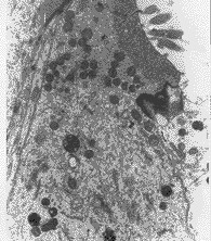毛細胞性白血病(圖5)