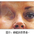 眼眶缺損