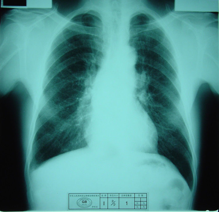 肺鈣化灶