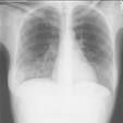 肺部先天性疾病