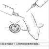 包皮環切術(包皮環切)