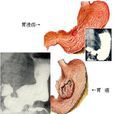 高位胃癌 高位胃癌