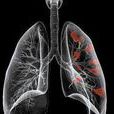 肺內圓形實質性或囊性腫塊