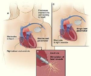 植入了心臟起搏器的胸腔剖面圖