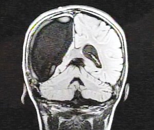顯示右腦缺失的醫學掃描照片