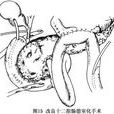 胰腺破裂 胰腺破裂
