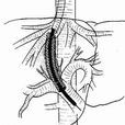 經頸靜脈肝內門體靜脈內支架分流術