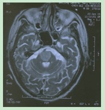 腦幹梗死MRI表現：T2WI相