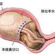 胎膜羊水
