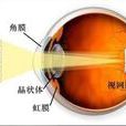 不規則散光