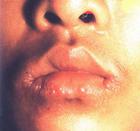 口腔皰疹病毒感染