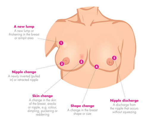 急性哺乳期乳腺炎