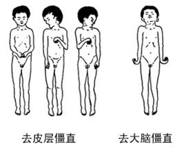 去大腦僵直