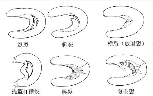 半月板縫合術