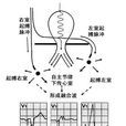 室性融合波 室性融合波