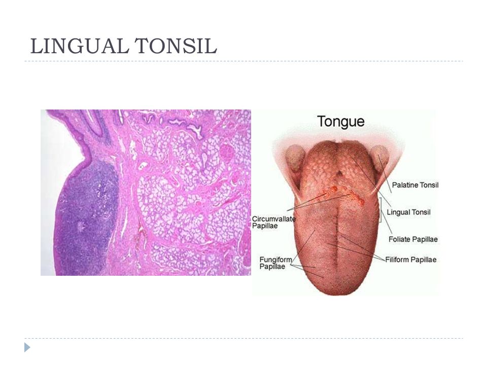 舌扁桃體