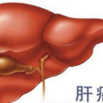 肝癌表現 肝癌表現