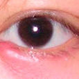 眼瞼膿腫