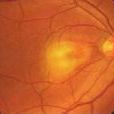 視網膜疾病