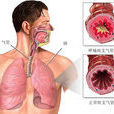 支氣管哮喘病