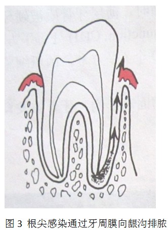 牙髓病變對牙周的影響