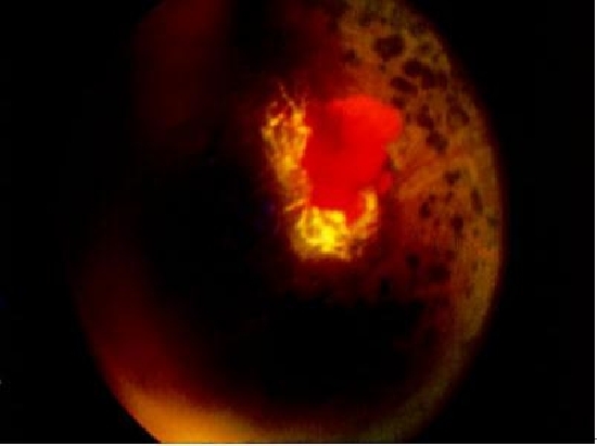 鐮狀細胞貧血視網膜病變