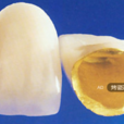 烤瓷冠 烤瓷冠