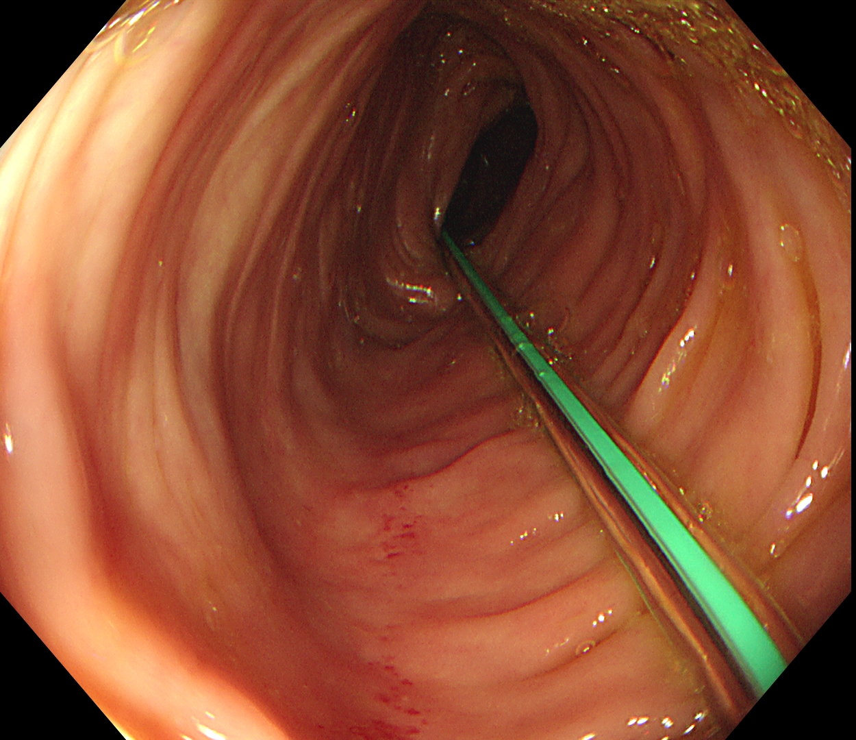經內鏡腸道植管術