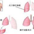 肺葉切除術 肺葉切除術
