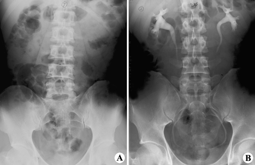 正常腹X線平片（A）和靜脈腎盂造影片（B）