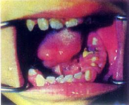 口腔頜面部惡性腫瘤