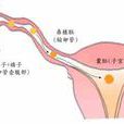 輸卵管閉塞