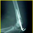 肱骨髁上骨折切開復位內固定術