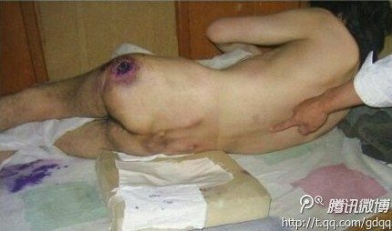 2006年博文稱被東莞治安員毆打致終生殘疾