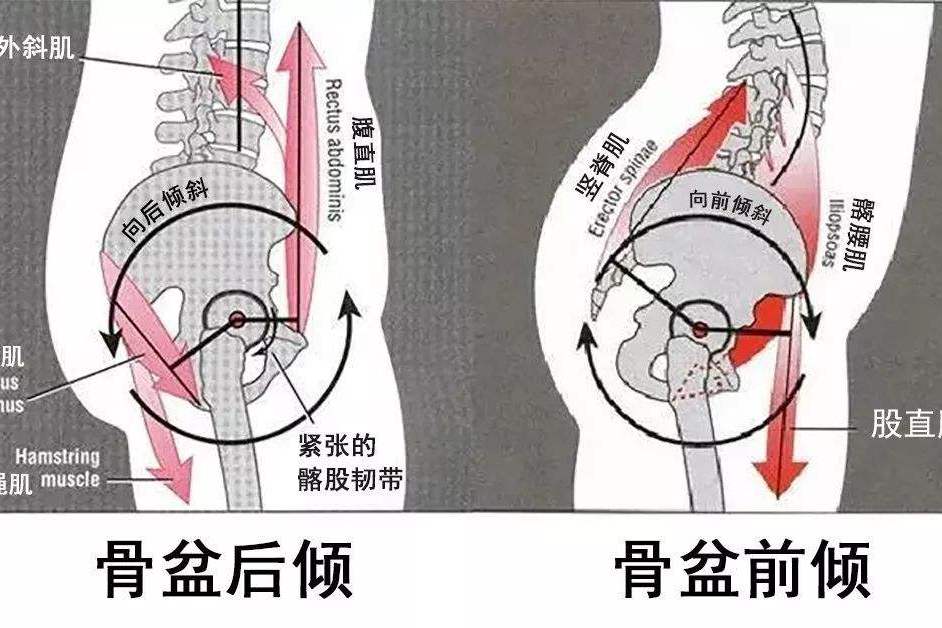 骨盆後傾 骨盆後傾