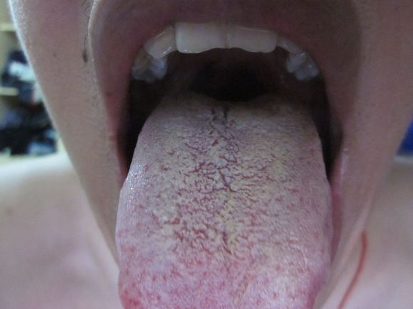 舌苔黃膩