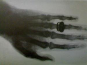 第一張X光片