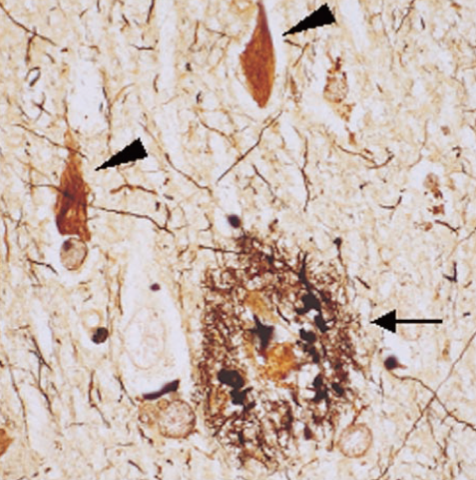 AD患者的大腦在顯微鏡下觀察到的不可溶的澱粉樣蛋白積聚物