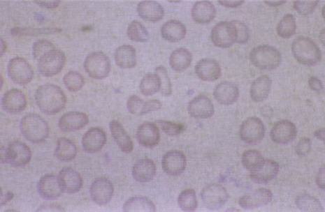 小兒缺鐵性貧血細胞圖